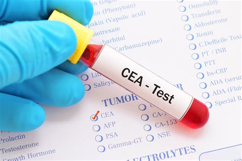 laboratory for analysis colon cancer|colon cancer blood work results.